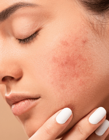 Leke Bakımı İzmir | Pakalın Güzellik